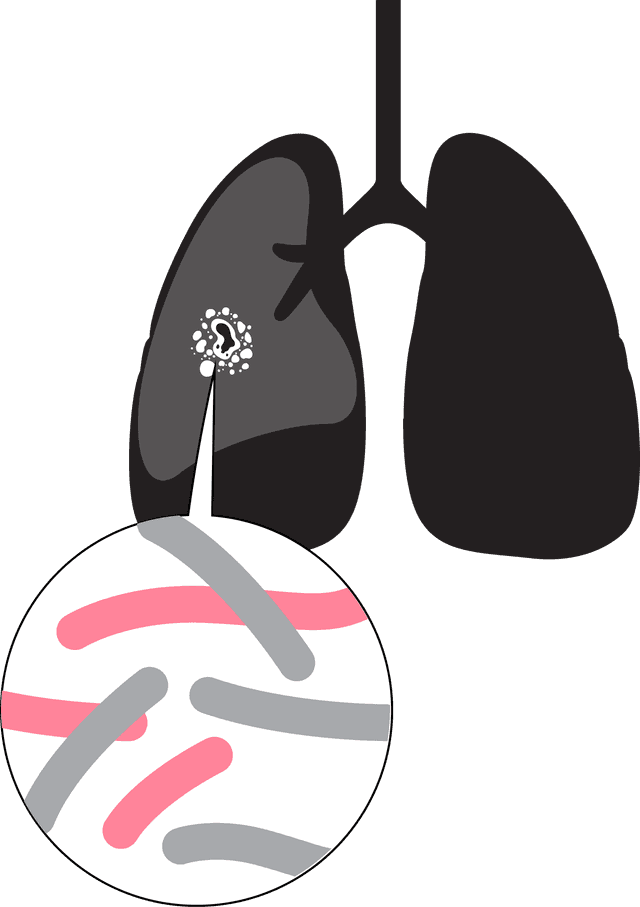 TB in granuloma